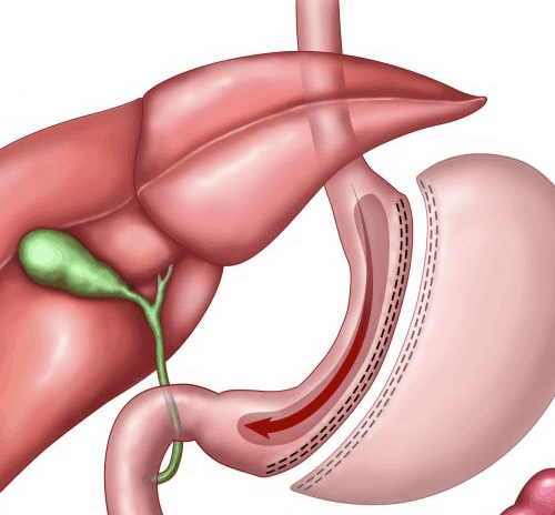 Obesity Surgery